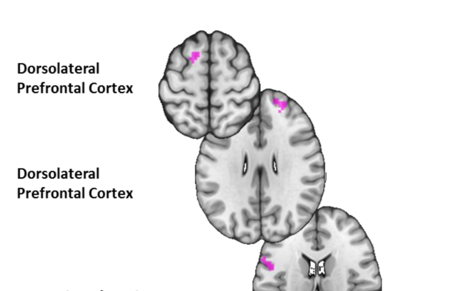 PTSD: Daniel Schechter Published a New Study on Parental Reflective Functioning