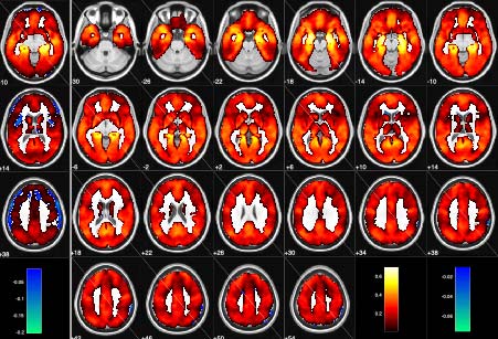 Un mauvais câblage au cœur du cerveau mène à la psychose