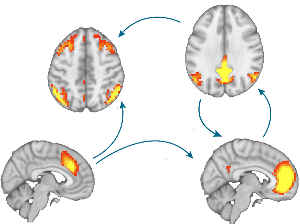 Is schizophrenia the cost of a poor brain optimisation?